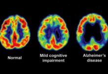 Mild cognitive impairment treatment