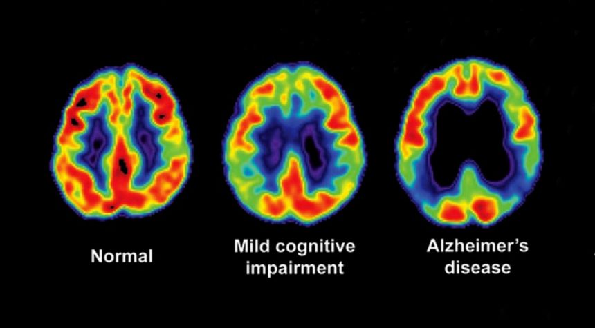 Cognitive impairment mild alzheimer mci Mild cognitive impairment treatment
