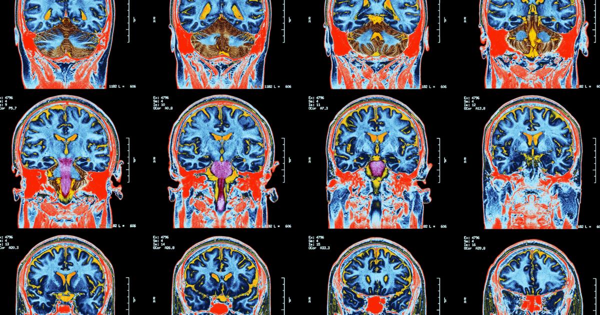 Long covid cognitive effects