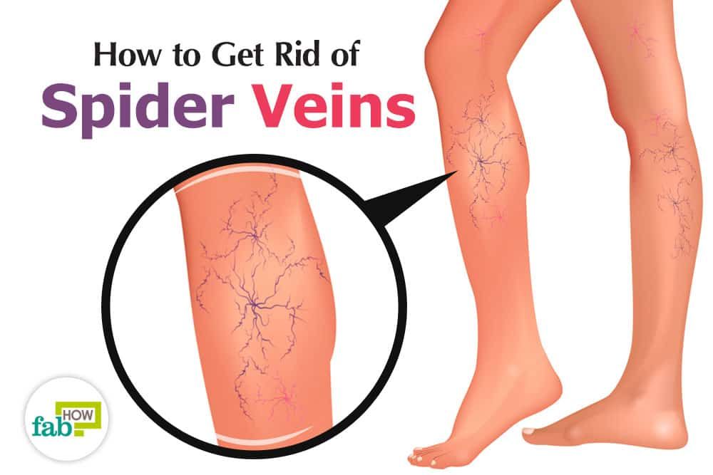 Spider veins telangiectasias blood vessels