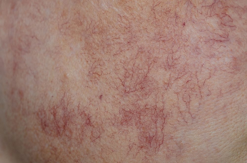 Spider veins telangiectasias blood vessels