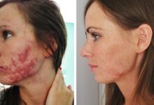 Acne adultos causas tratamientos