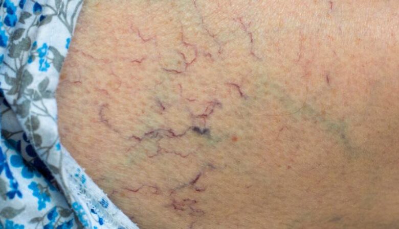 Spider veins telangiectasias blood vessels