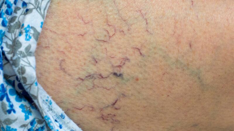 Spider veins telangiectasias blood vessels