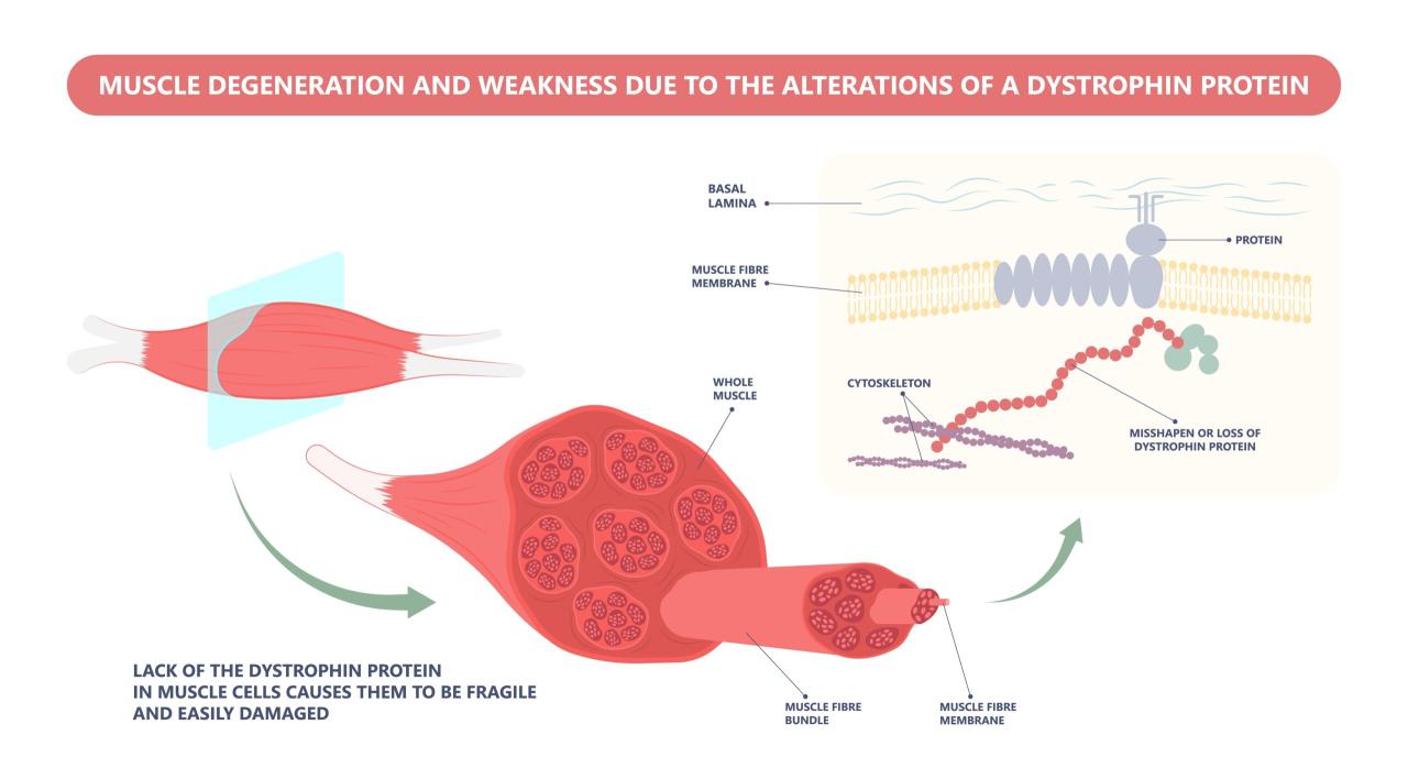 Gene therapy dmd elevidys