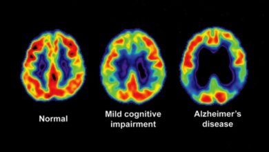 Mild cognitive impairment treatment